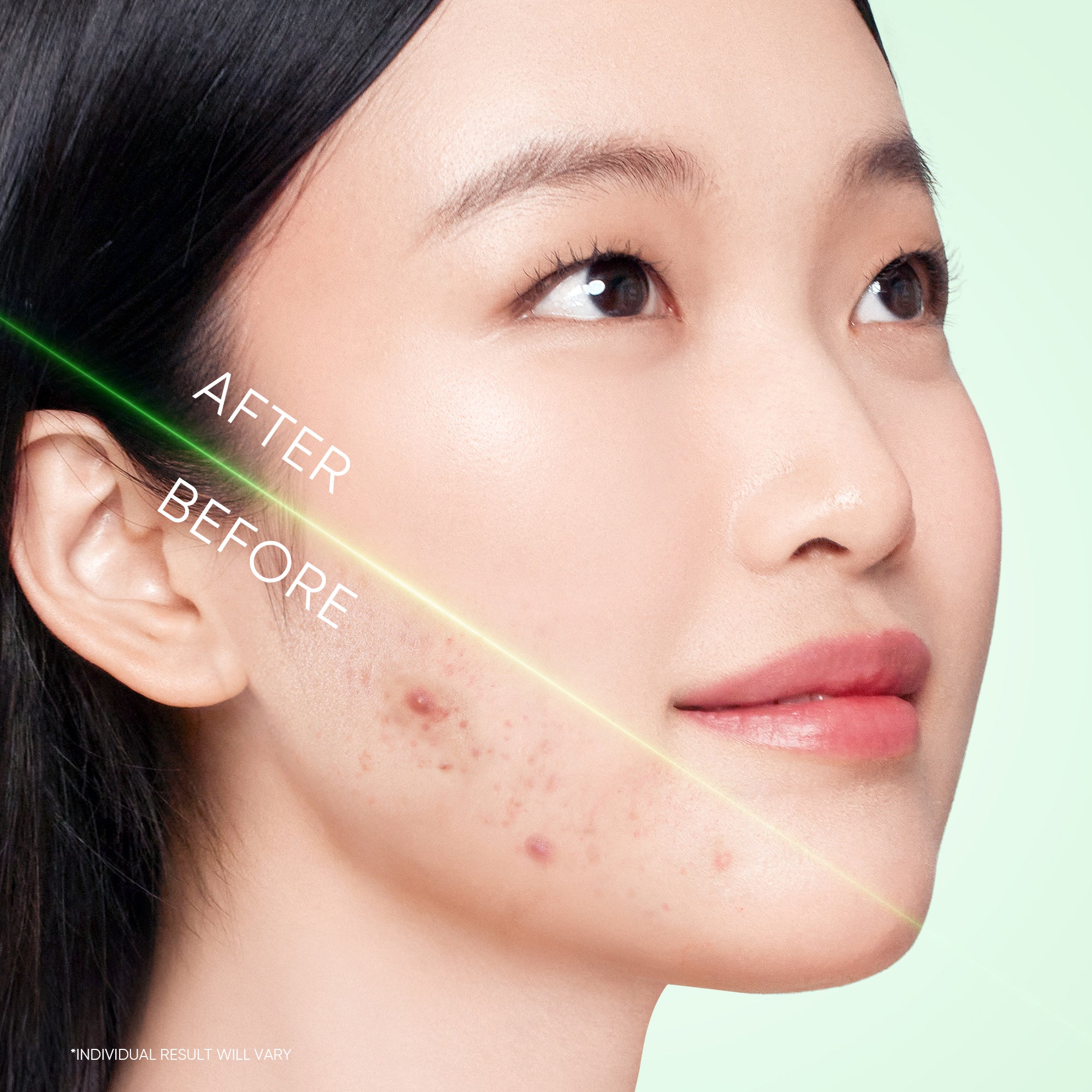 Limpiador en gel para acné con 3X de ácidos